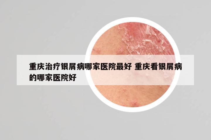 重庆治疗银屑病哪家医院最好 重庆看银屑病的哪家医院好