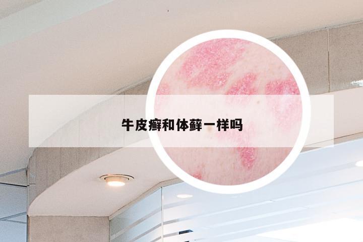 牛皮癣和体藓一样吗