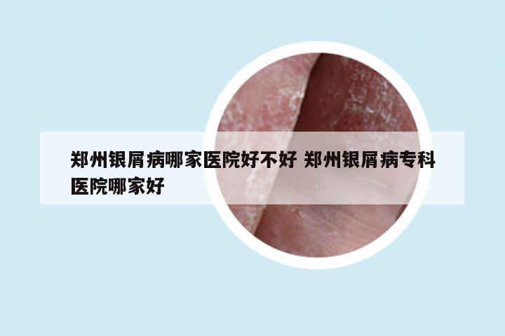 郑州银屑病哪家医院好不好 郑州银屑病专科医院哪家好