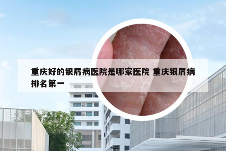 重庆好的银屑病医院是哪家医院 重庆银屑病排名第一