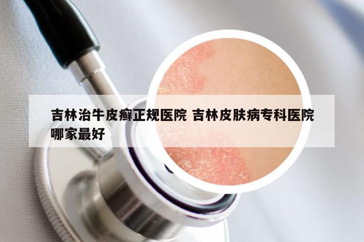 吉林治牛皮癣正规医院 吉林皮肤病专科医院哪家最好