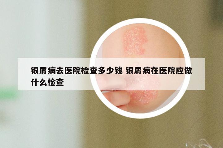 银屑病去医院检查多少钱 银屑病在医院应做什么检查
