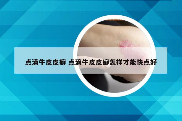 点滴牛皮皮癣 点滴牛皮皮癣怎样才能快点好