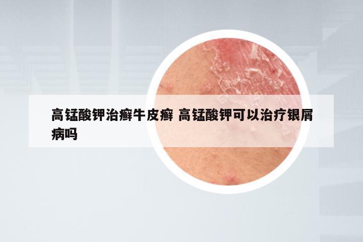 高锰酸钾治癣牛皮癣 高锰酸钾可以治疗银屑病吗