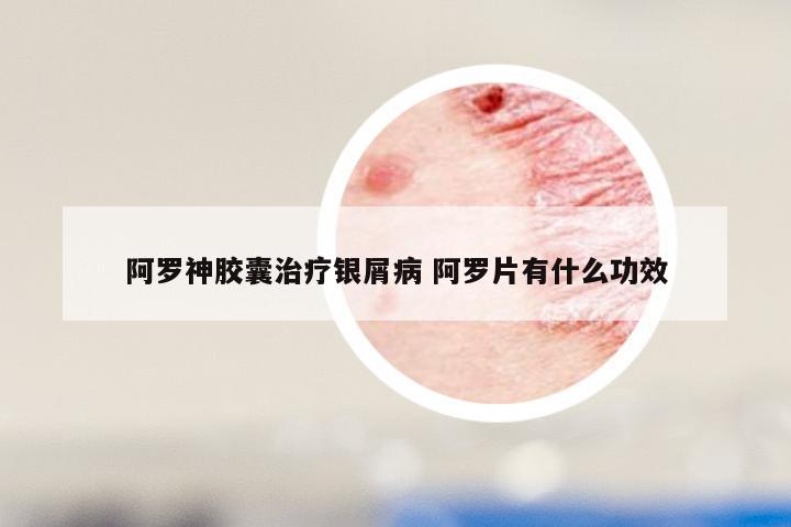 阿罗神胶囊治疗银屑病 阿罗片有什么功效