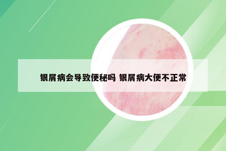 银屑病会导致便秘吗 银屑病大便不正常