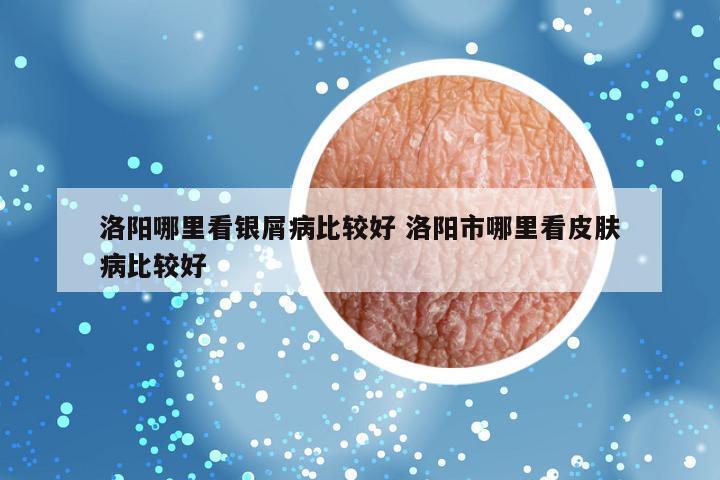 洛阳哪里看银屑病比较好 洛阳市哪里看皮肤病比较好