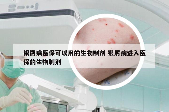 银屑病医保可以用的生物制剂 银屑病进入医保的生物制剂