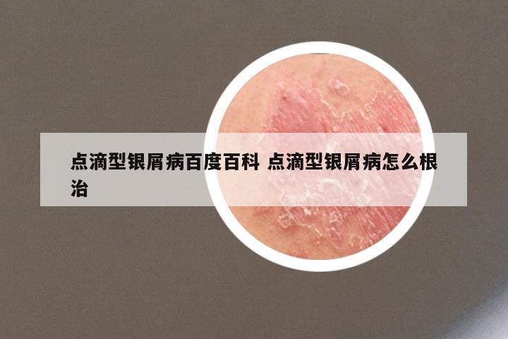 点滴型银屑病百度百科 点滴型银屑病怎么根治