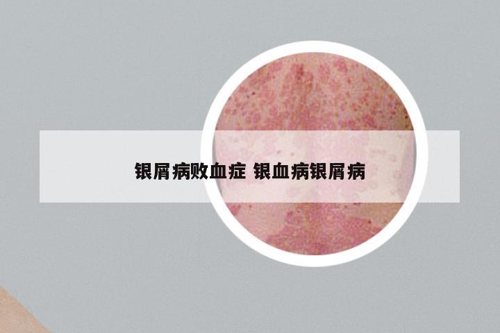 银屑病败血症 银血病银屑病