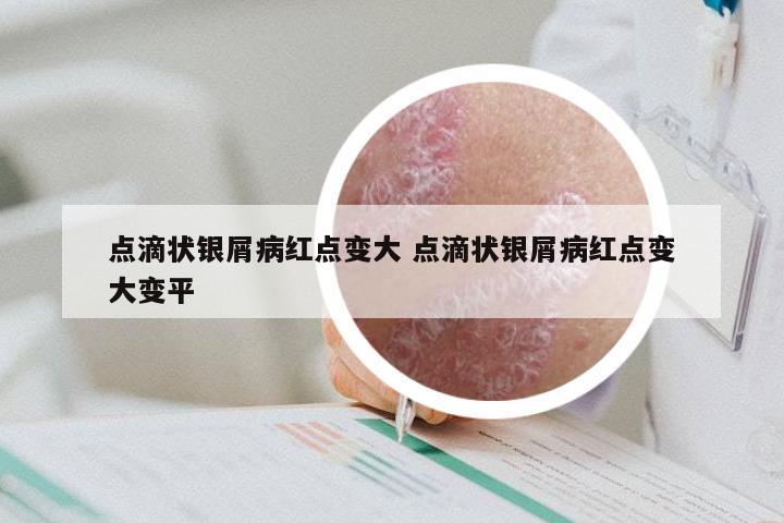 点滴状银屑病红点变大 点滴状银屑病红点变大变平