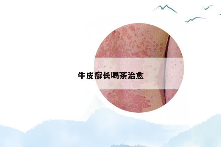 牛皮癣长喝茶治愈