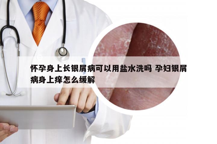 怀孕身上长银屑病可以用盐水洗吗 孕妇银屑病身上痒怎么缓解