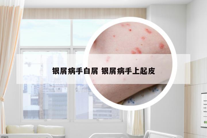银屑病手白屑 银屑病手上起皮