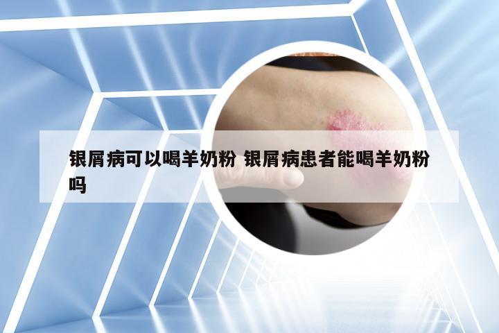 银屑病可以喝羊奶粉 银屑病患者能喝羊奶粉吗