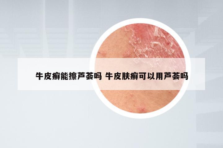 牛皮癣能擦芦荟吗 牛皮肤癣可以用芦荟吗