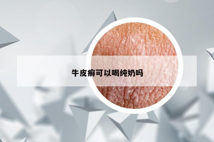 牛皮癣可以喝纯奶吗