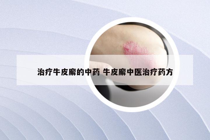 治疗牛皮廨的中药 牛皮廨中医治疗药方