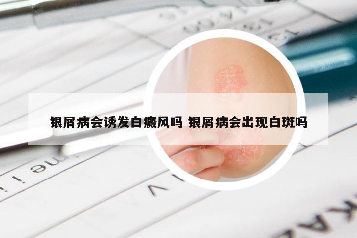 银屑病会诱发白癜风吗 银屑病会出现白斑吗