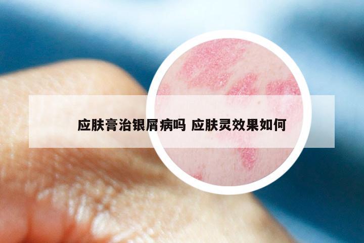 应肤膏治银屑病吗 应肤灵效果如何