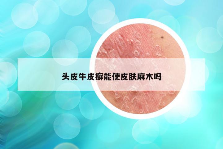 头皮牛皮癣能使皮肤麻木吗