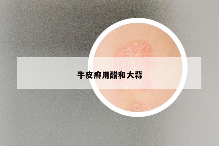 牛皮癣用醋和大蒜