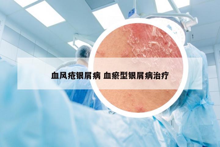 血风疮银屑病 血瘀型银屑病治疗
