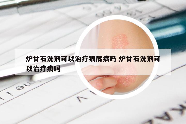 炉甘石洗剂可以治疗银屑病吗 炉甘石洗剂可以治疗癣吗