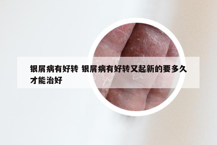 银屑病有好转 银屑病有好转又起新的要多久才能治好