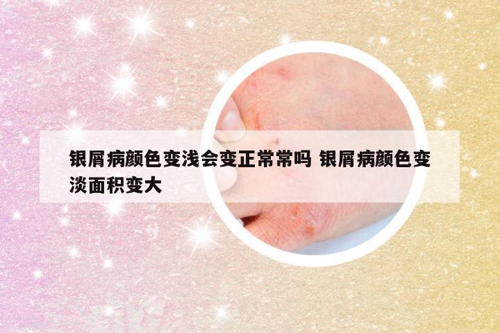 银屑病颜色变浅会变正常常吗 银屑病颜色变淡面积变大