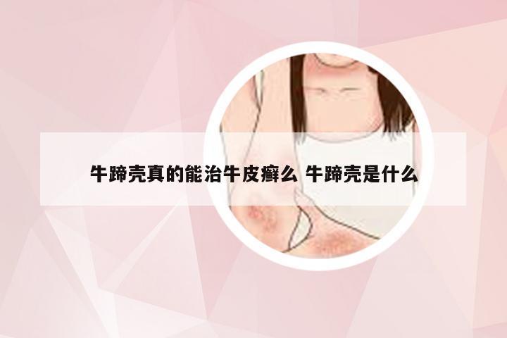 牛蹄壳真的能治牛皮癣么 牛蹄壳是什么