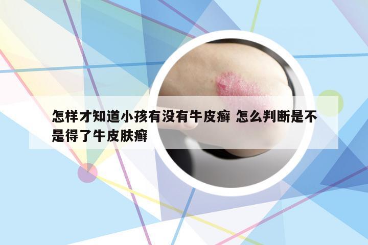 怎样才知道小孩有没有牛皮癣 怎么判断是不是得了牛皮肤癣