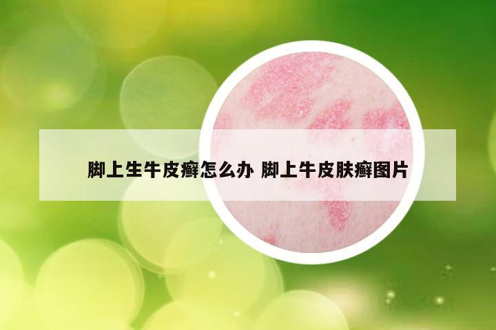 脚上生牛皮癣怎么办 脚上牛皮肤癣图片