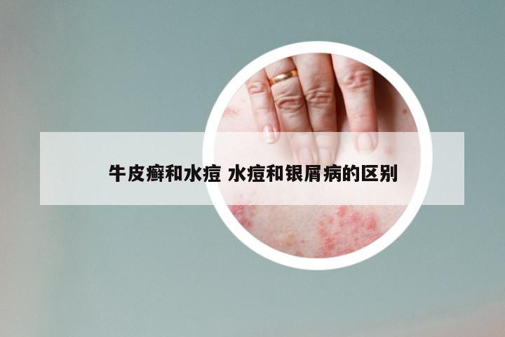 牛皮癣和水痘 水痘和银屑病的区别