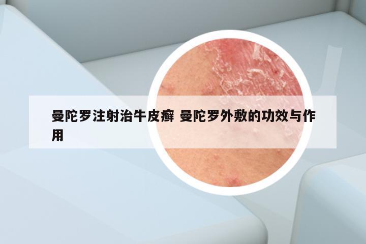 曼陀罗注射治牛皮癣 曼陀罗外敷的功效与作用
