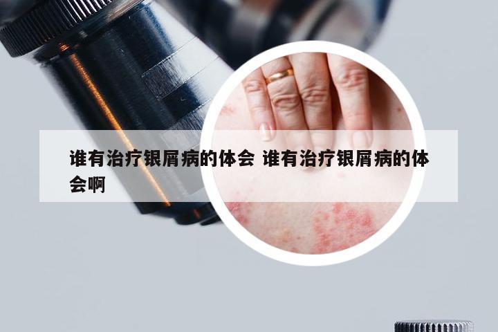 谁有治疗银屑病的体会 谁有治疗银屑病的体会啊