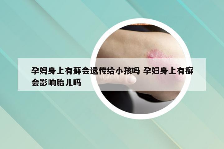 孕妈身上有藓会遗传给小孩吗 孕妇身上有癣会影响胎儿吗