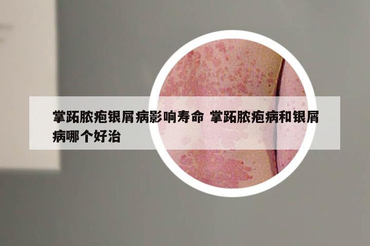 掌跖脓疱银屑病影响寿命 掌跖脓疱病和银屑病哪个好治