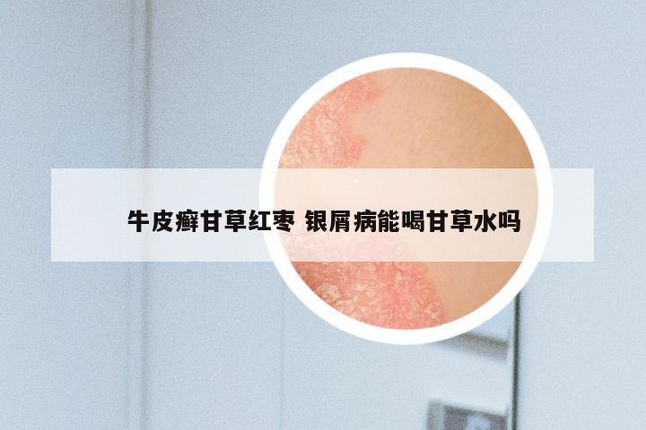 牛皮癣甘草红枣 银屑病能喝甘草水吗