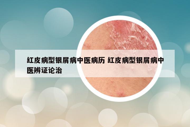 红皮病型银屑病中医病历 红皮病型银屑病中医辨证论治