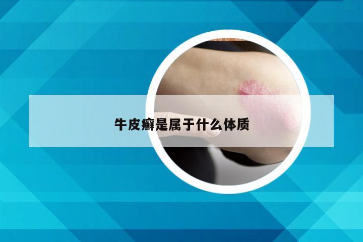 牛皮癣是属于什么体质