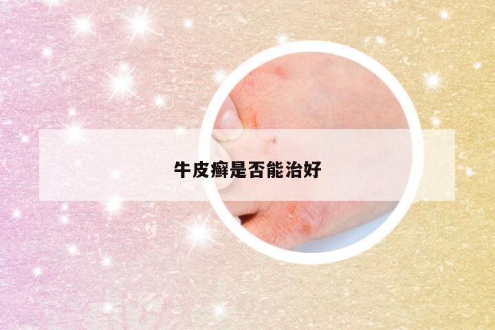 牛皮癣是否能治好