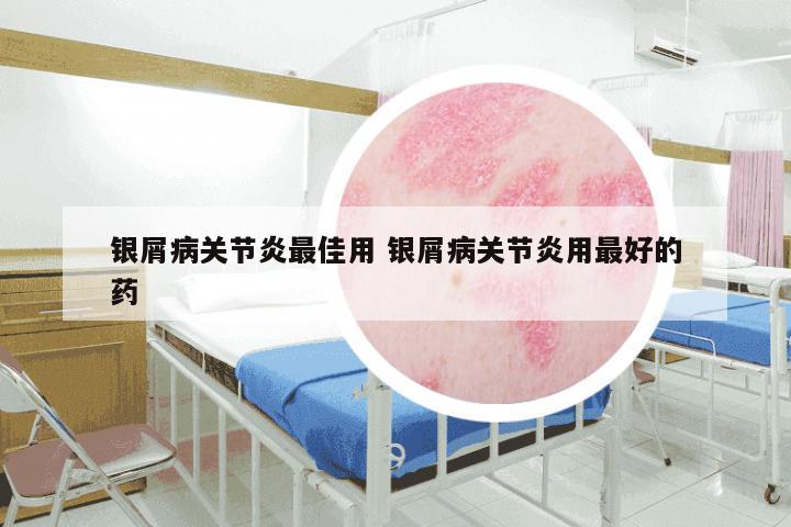 银屑病关节炎最佳用 银屑病关节炎用最好的药