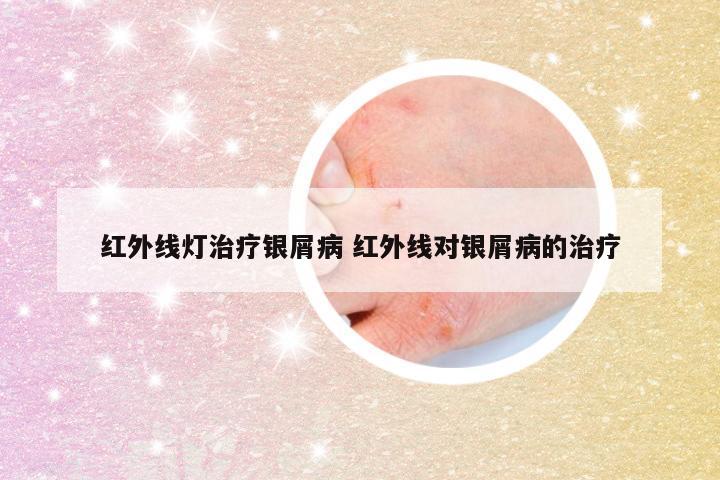 红外线灯治疗银屑病 红外线对银屑病的治疗