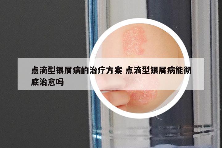 点滴型银屑病的治疗方案 点滴型银屑病能彻底治愈吗