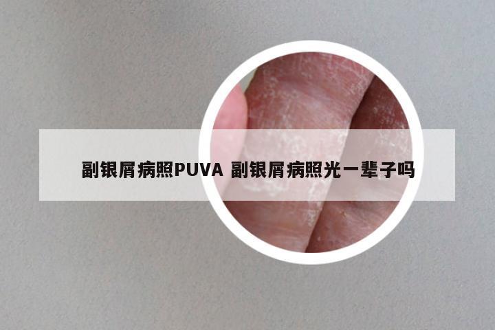 副银屑病照PUVA 副银屑病照光一辈子吗