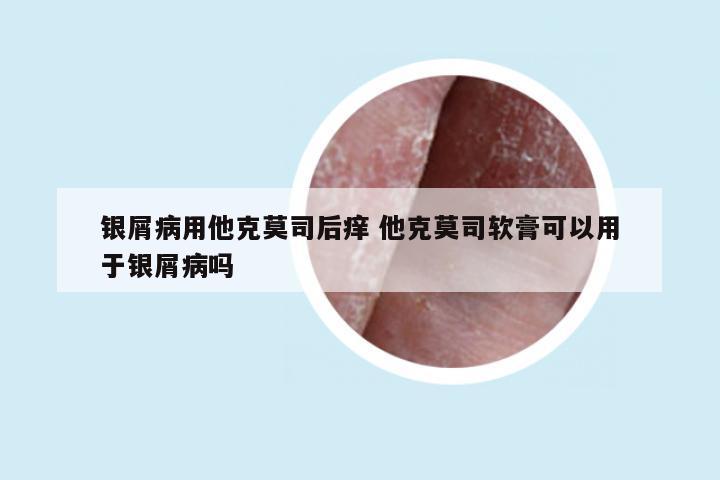 银屑病用他克莫司后痒 他克莫司软膏可以用于银屑病吗