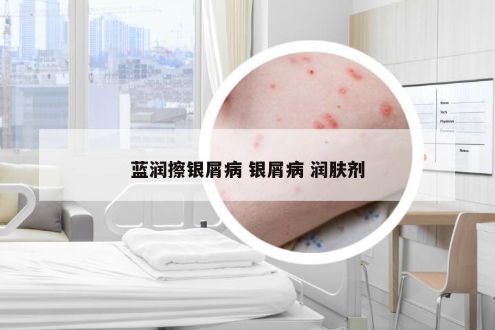 蓝润擦银屑病 银屑病 润肤剂