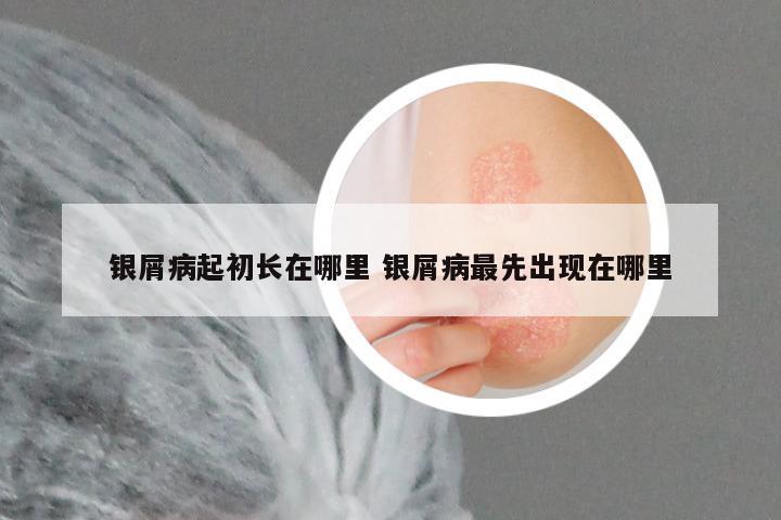 银屑病起初长在哪里 银屑病最先出现在哪里