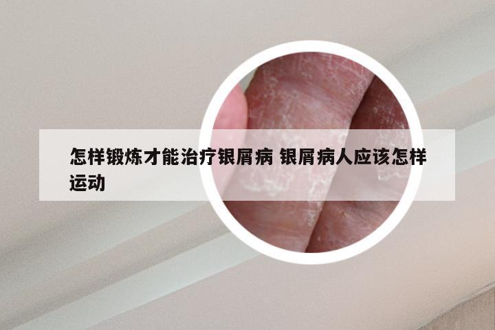 怎样锻炼才能治疗银屑病 银屑病人应该怎样运动